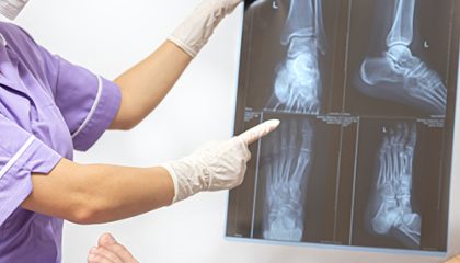 Female doctor in a blue medical gown checking broken leg and shows the male patient lateral projection x-ray of foot and ankle.